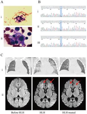 Hemophagocytic lymphohistiocytosis caused by multiple infections during primary chemotherapy for pediatric acute lymphoblastic leukemia: a case report